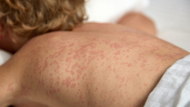 Foto: Voor of tegen vaccineren? Op de Biblebelt wordt het antwoord zorgvuldig verpakt